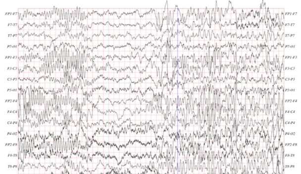 MIT论文:用AI辅助写作业,大脑不仅会变懒、还会变“笨”!